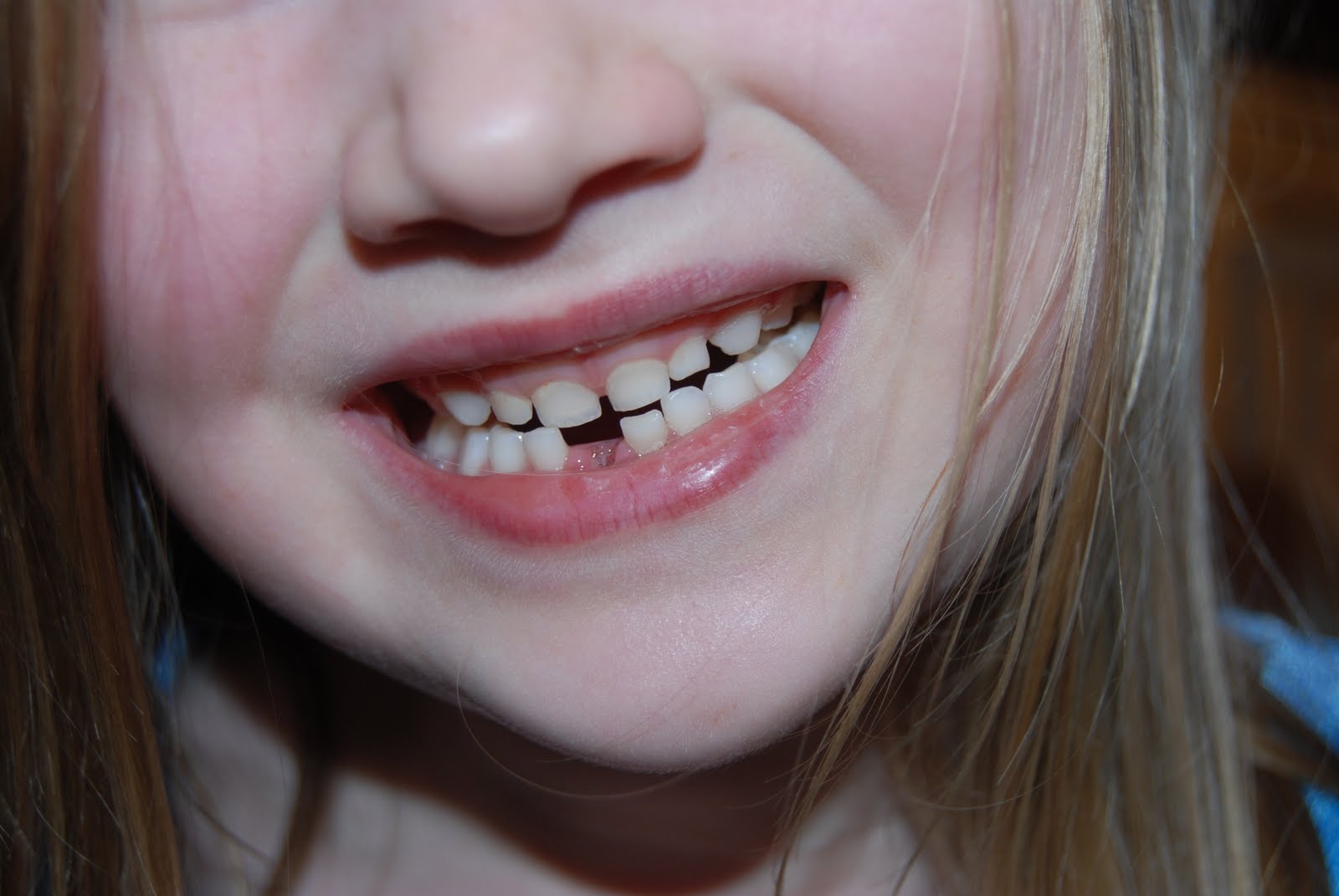 the wilfords Wobbly Teeth