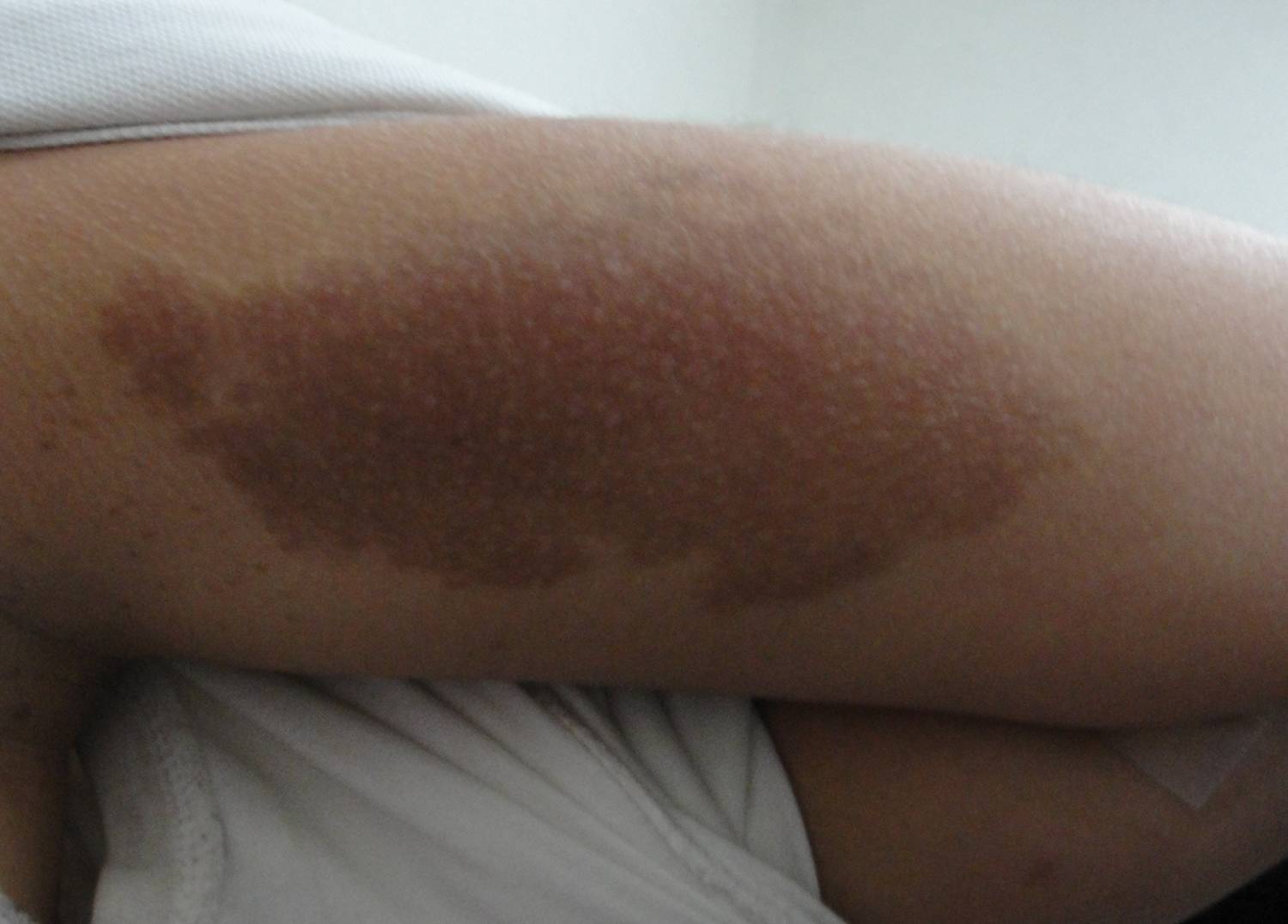 Manchas+Rojas+En+Los+Brazos Medicina APS: Niña de 15 años con Manchas Café con Leche
