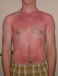 Example of a Sunburn (QuinnHK Wikipedia)