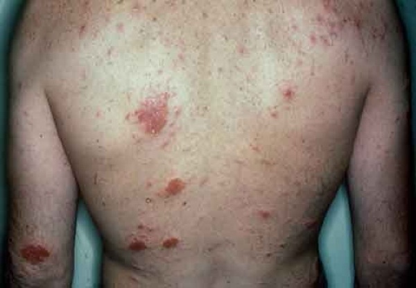 Dry Itchy Skin In Winter Home Remedies Dry Itchy Skin In Winter Home Remedies