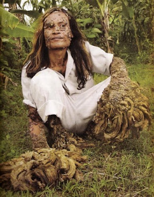 Tree man 'who grew roots' may be cured Tree man 'who grew roots' may be cured