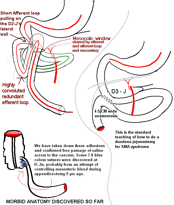 My encounter with Surgical curiosities: • 3 Surgeries ... sma syndrome diagram 