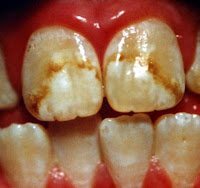 manchas fluorosis dental