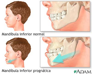 mandibula adelantada cirugia ortognatica