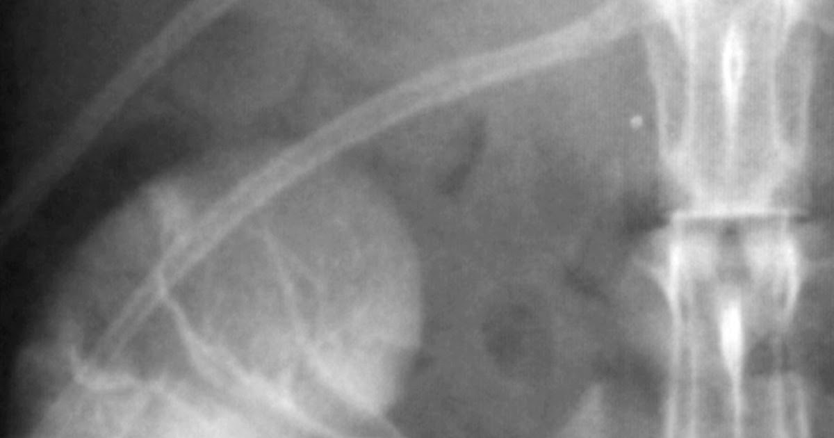 Renal Fellow Network Renal sympathetic nerve ablation for refractory