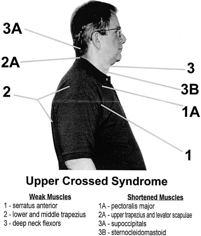 Upper Cross Syndrome