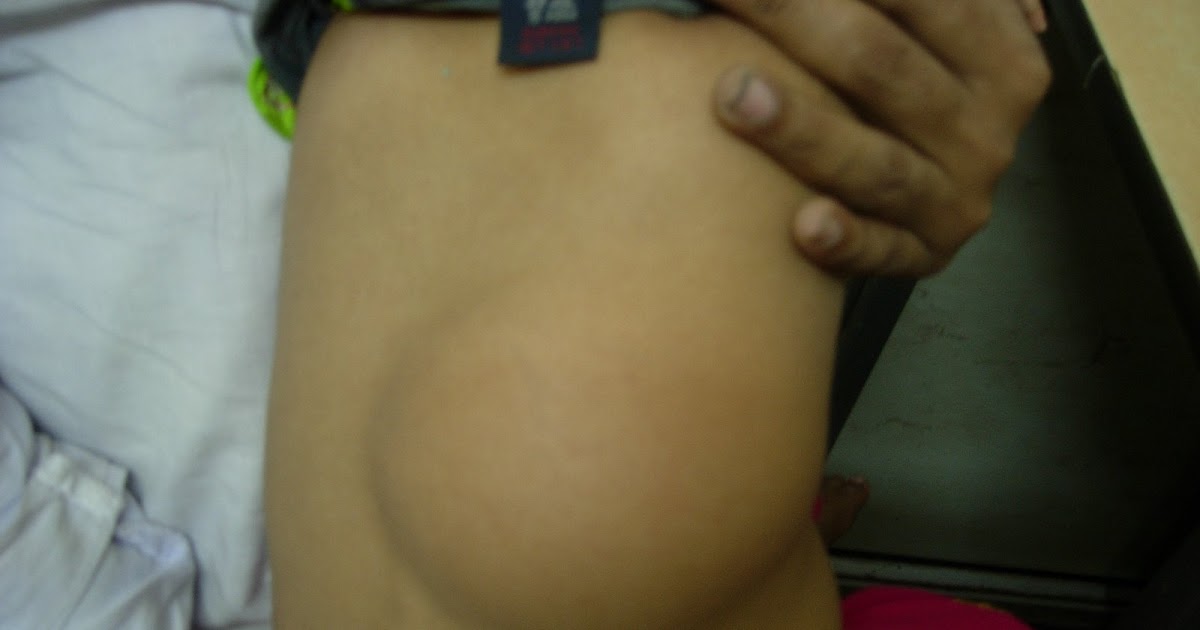 Lipoma Over Back