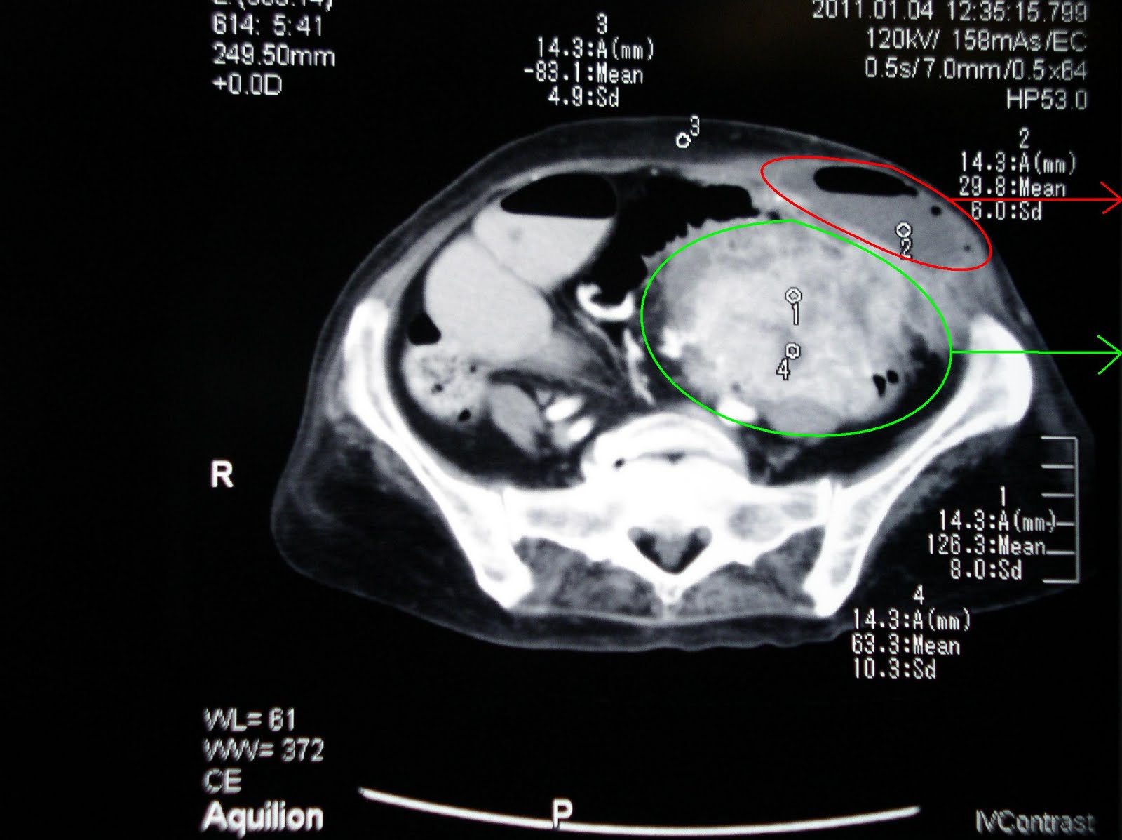 Ct+scan+abdomen+cancer