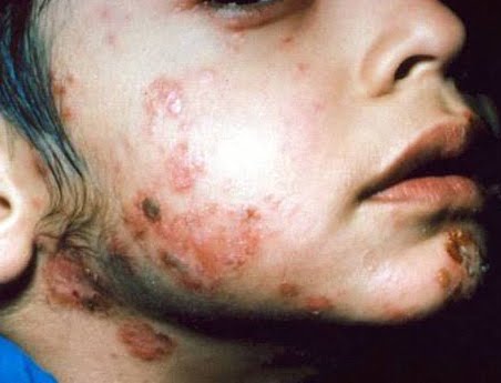 Impetigo Around Mouth