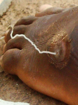 Medical Students Blog: Guinea Worm : Dracunculiais CDC article Medical Students Blog: Guinea Worm : Dracunculiais CDC article