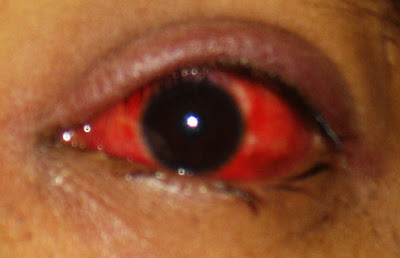 gonorrhea symptoms in eyes