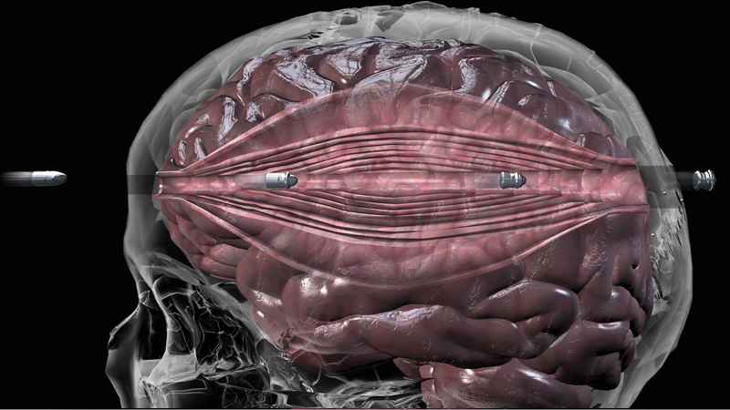 a bullet in the brain A person's chances of surviving a bullet wound to the brain depend on the areas of the brain that are struck, the velocity of the bullet and whether the bullet exits the brain. a bullet in the brain A person's chances of surviving a bullet wound to the brain depend on the areas of the brain that are struck, the velocity of the bullet and whether the bullet exits the brain.