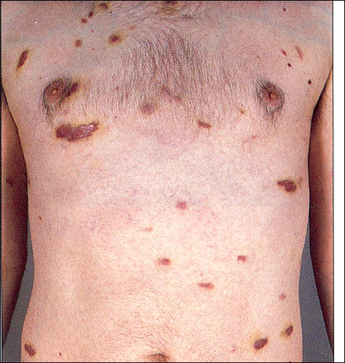 Aids Kaposi