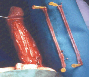 Penile Implants for Erectile Dysfunction