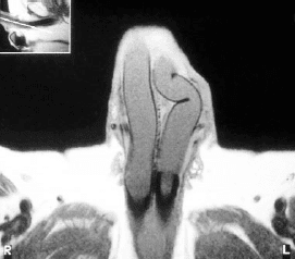 Penile Implants for Erectile Dysfunction