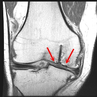 Ocd Knee Mri