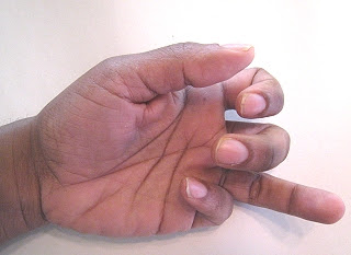 Ring Finger Swelling At Night Ring Finger Swelling At Night