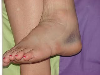 Ankle Sprain Images