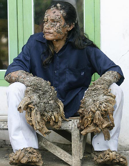 Tree Man Dede Koswara tree man pictures. Tree Man Dede Koswara