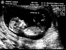First Sonogram 2 picture