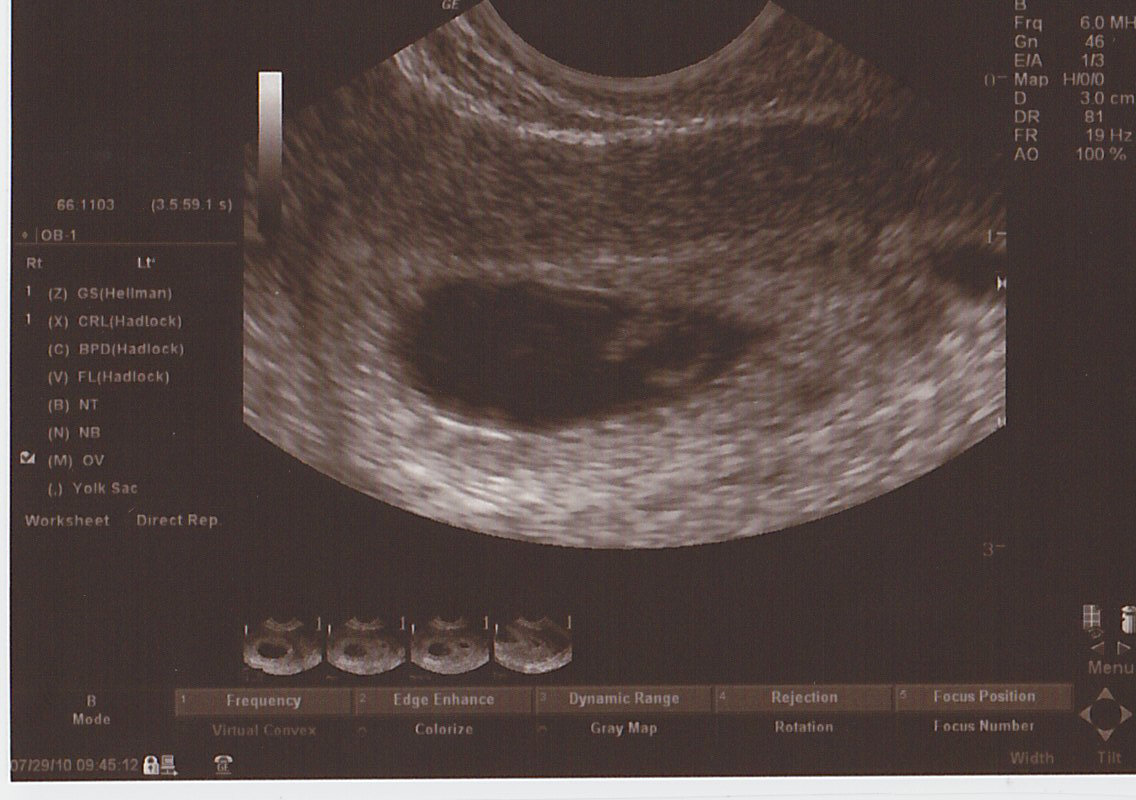 (I will post the ultrasound pictures tonight. 6wks5dys 072910 Gay Fisting With Alexsander Freitas & Patrick Ryan