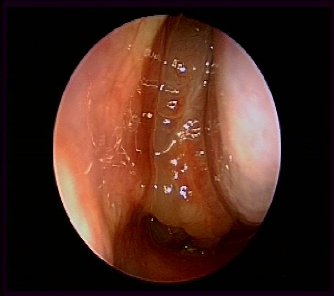 Ct+scan+sinus+polyps