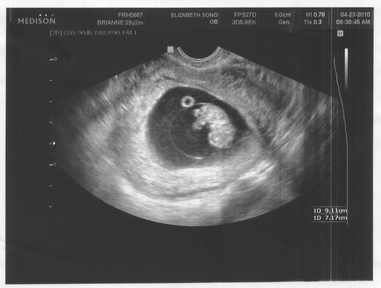 Week 9 Ultrasound