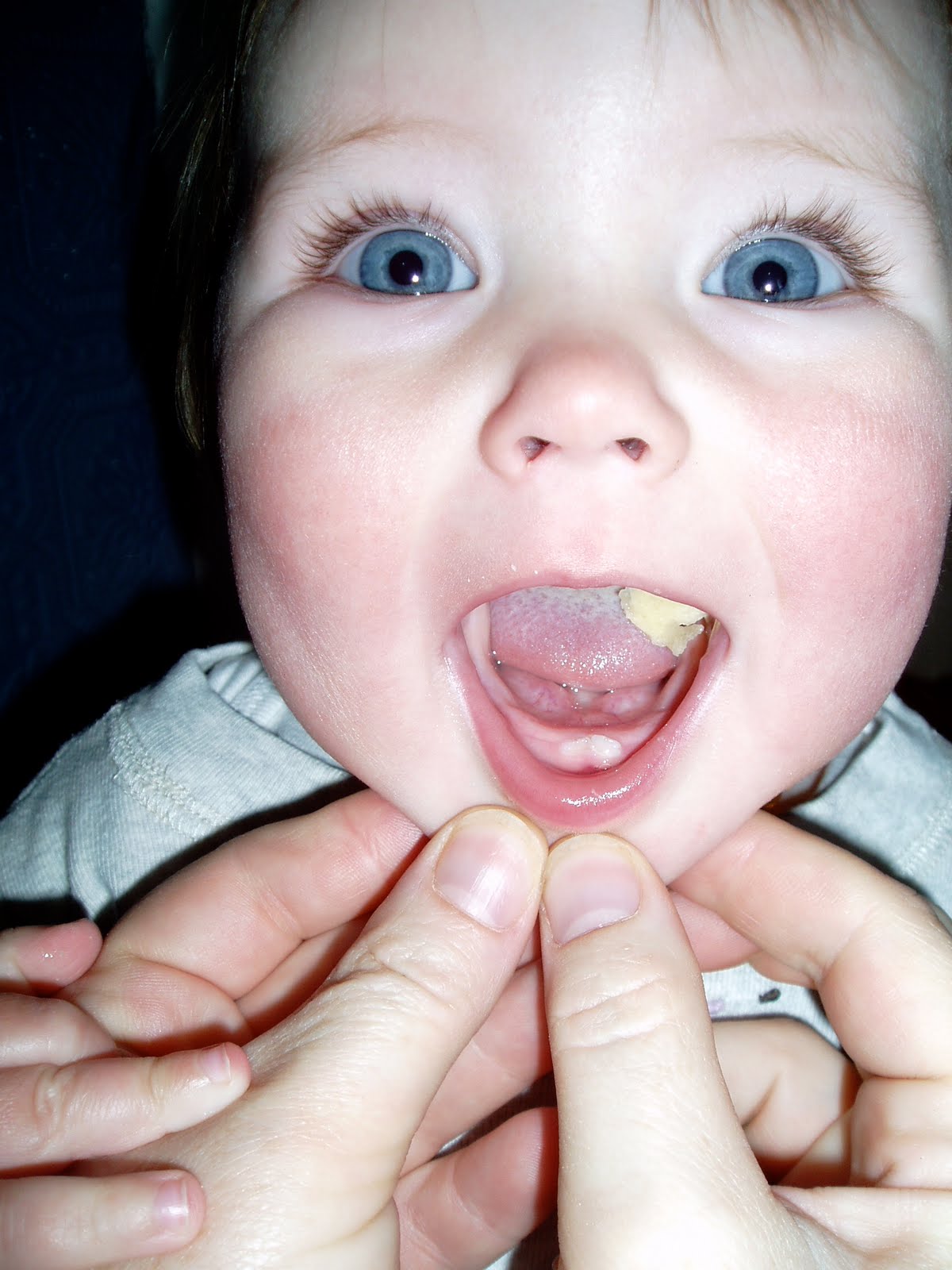 Bitten Off Tongue