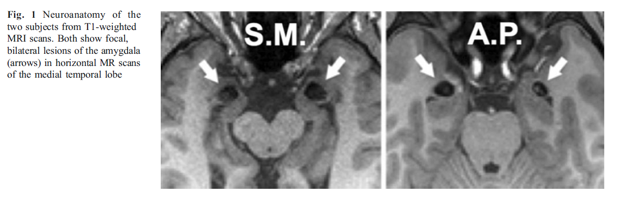 Case study amygdala picture