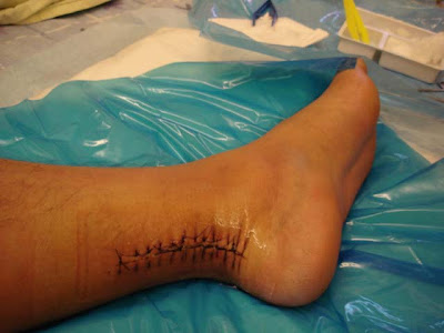 One last look at my stitches.