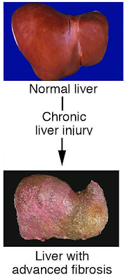 thesis on alcoholic liver disease High intake of alcohol obesity increases the severity of alcohol liver disease in its three stages hepatitis c has also been identified as a risk factor for alcoholic liver disease, (basra, 2011. thesis on alcoholic liver disease High intake of alcohol obesity increases the severity of alcohol liver disease in its three stages hepatitis c has also been identified as a risk factor for alcoholic liver disease, (basra, 2011.