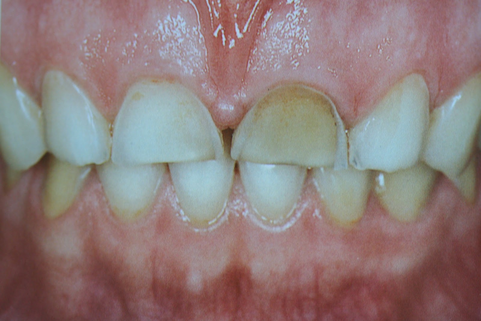 TRATAMIENTOS DENTALES Abrasión Dental