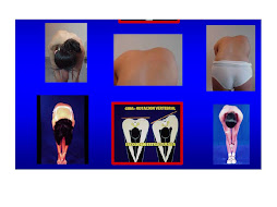 Indicios de Escoliosis