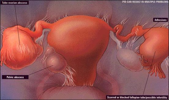 Infertile Female