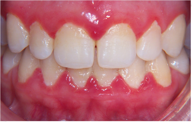 placa+bacteriana Tratamento da Gengivite - 2019 placa+bacteriana
