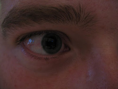 before-lasik-eye-surgery--before-lasik_eye_laser_vision_surgery_tips