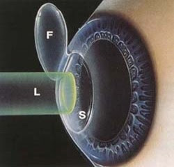 ellent+Result+From+Lasik+Amandag's+Lasik+Reviews