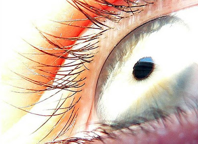 lasik+candidacy+matter+is+pupil+diameter