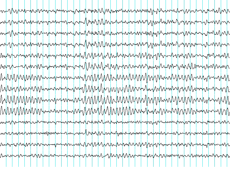 [ElectroEncephalogram.png]