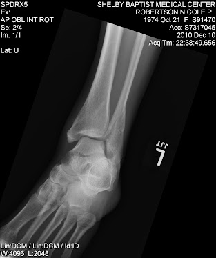 x ray #3 on the night of injury