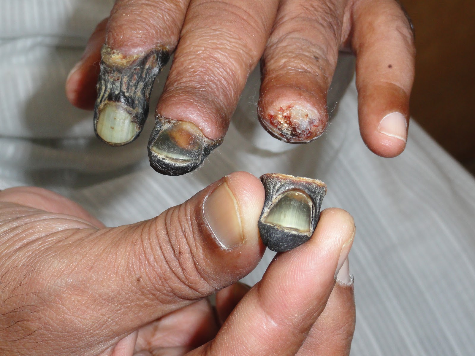 diabetic fingers