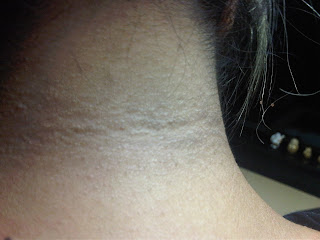DR. LUDWIG JOHNSON: Manchas y Verrugas en el cuello. DR. LUDWIG JOHNSON: Manchas y Verrugas en el cuello.