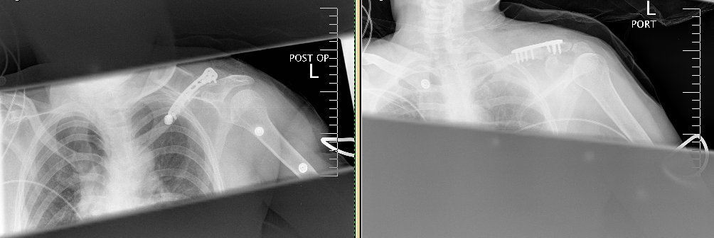 [clavicle+with+hardware+2+views.jpg]