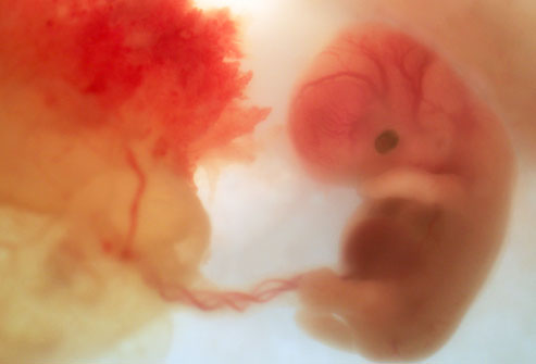 abortion at 8 weeks. 8 weeks the heart is beating.