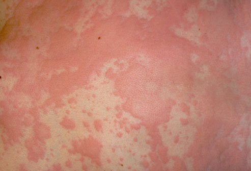 Topical steroids for genital psoriasis