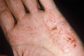 Steroid cream for eczema on hands