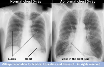 ray healthy lungs chest normal lung heart results rays mass right problems iodine detect circulatory