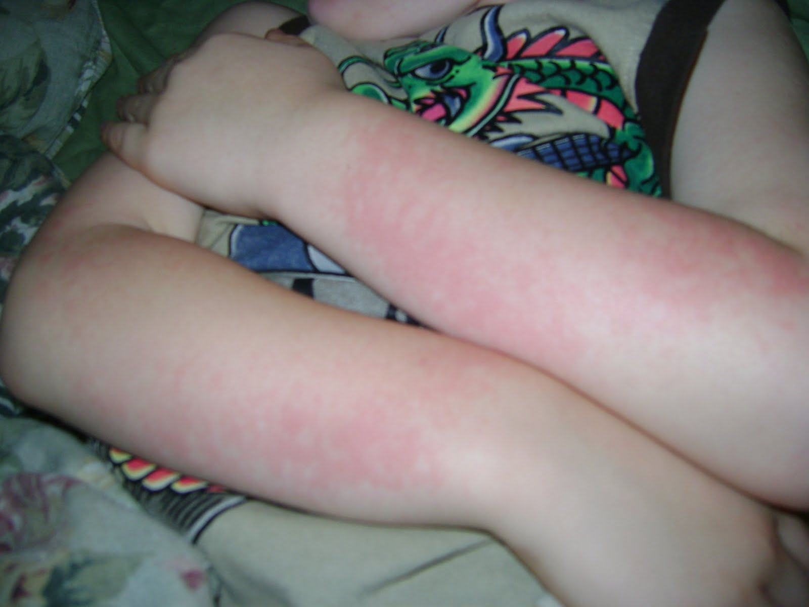 Rashes On Forearms