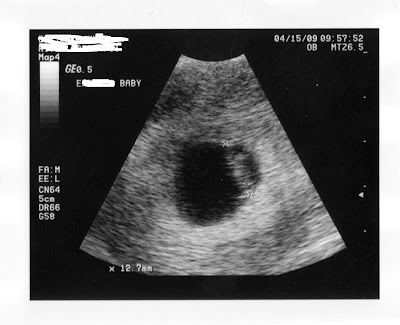 sonogram 5 weeks. 12 5 week ultrasound. sonogram 5 weeks.
