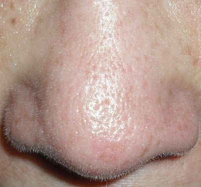 Big Nose Pores